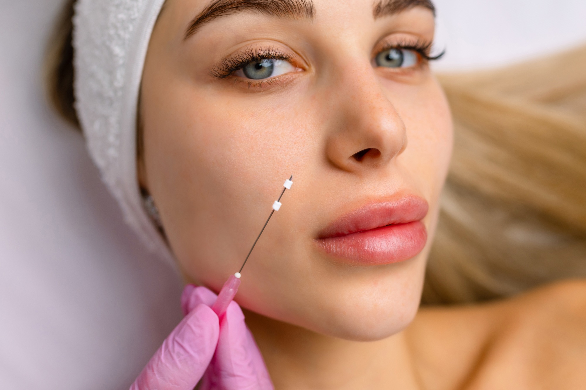 Face lifting PDO Suture operation. innovative technique of New thread lift, cosmetologist preparing