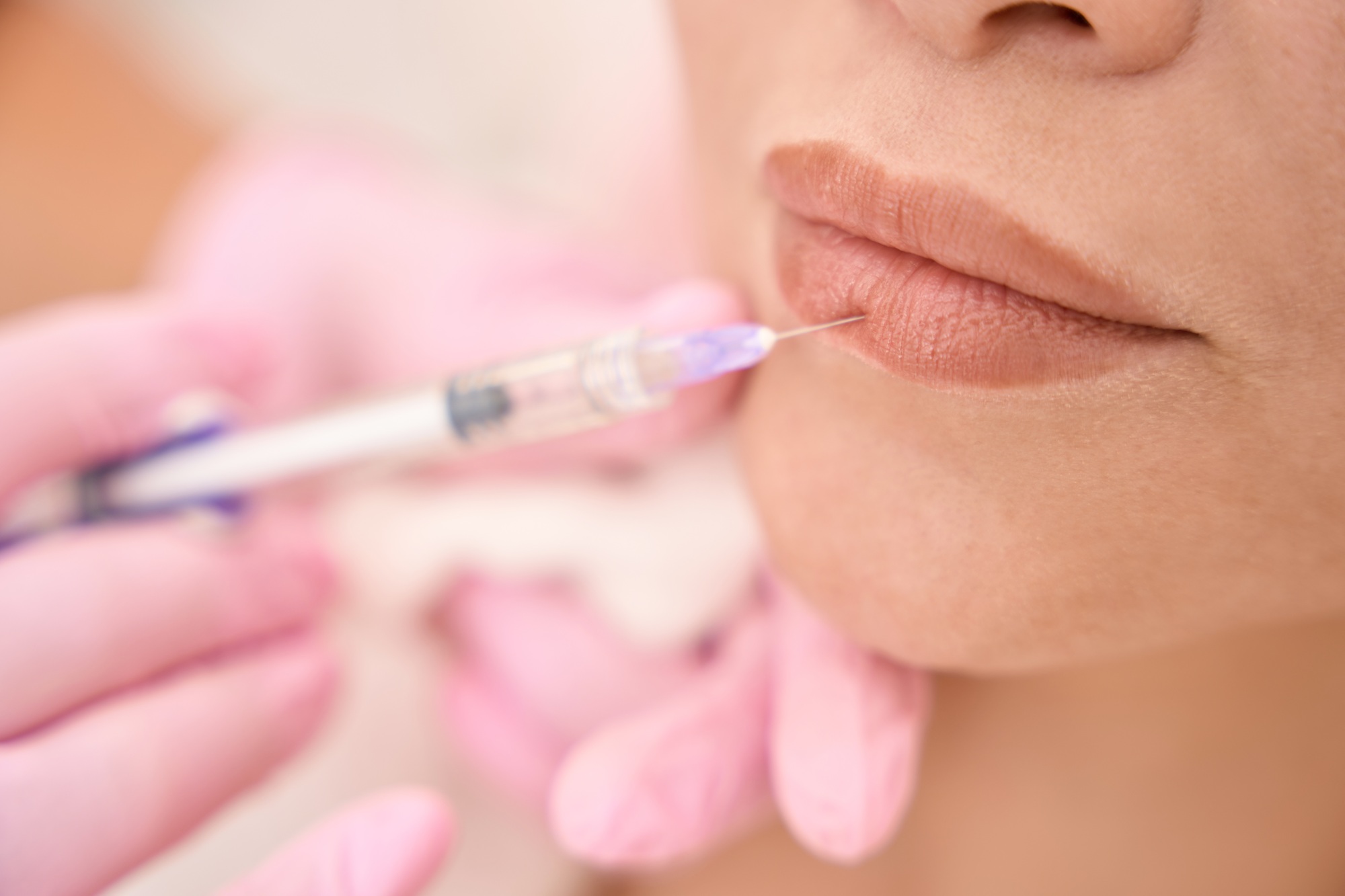Remodelación labial en estética dermatológica Almería